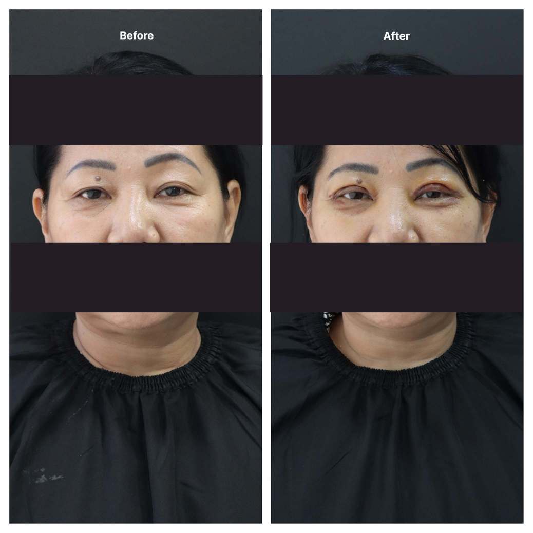 Eyelid Surgery KOQ10